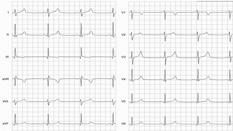Sinus Bradycardia 12 Lead EKG